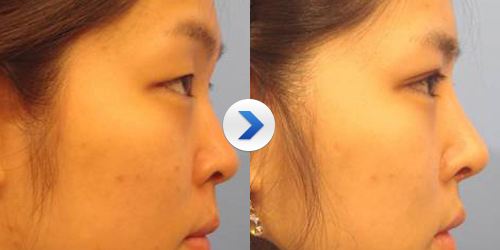 假體<a href=http://m.f3bb6.cn/listinfo-737-0.html target=_blank class=infotextkey>隆鼻</a>要忌口多久