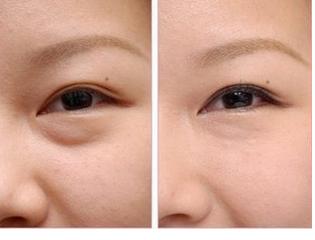 超聲波<a href=http://m.f3bb6.cn/listinfo-708-0.html target=_blank class=infotextkey>去眼袋</a>好不好呢