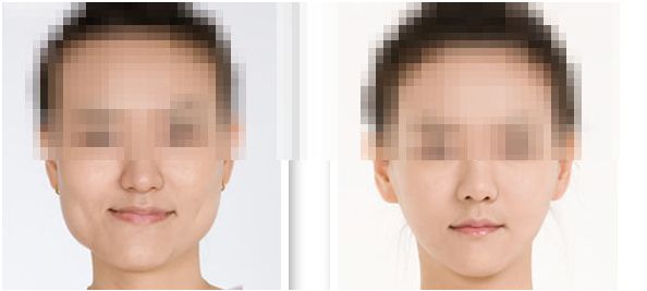 保障<a href=http://m.f3bb6.cn/listinfo-629-0.html target=_blank class=infotextkey>下頜角</a>整形手術成功術前準備十分必要