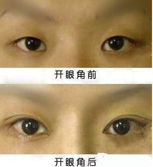 <a href=http://m.f3bb6.cn/listinfo-711-0.html target=_blank class=infotextkey>開眼角</a>手術修復哪里好