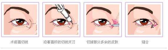 <a href=http://m.f3bb6.cn/listinfo-711-0.html target=_blank class=infotextkey>開眼角</a>多久才能恢復