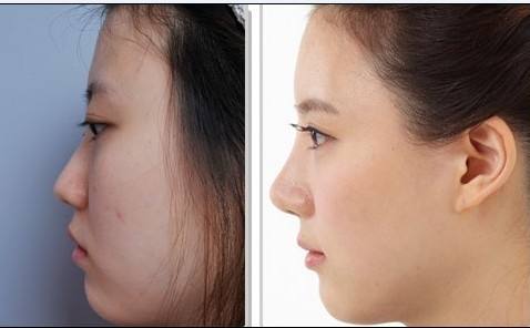 <a href=http://m.f3bb6.cn/listinfo-737-0.html target=_blank class=infotextkey>隆鼻</a>術后吃什么好的快