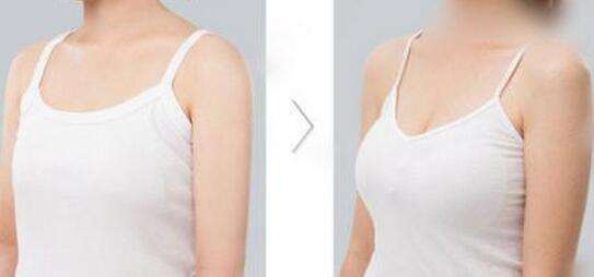 假體<a href=http://m.f3bb6.cn/listinfo-618-0.html target=_blank class=infotextkey>隆胸</a>能看出來嗎