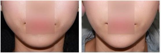 經期打<a href=http://m.f3bb6.cn/listinfo-631-0.html target=_blank class=infotextkey>瘦臉</a><a href=http://m.f3bb6.cn/listinfo-614-0.html target=_blank class=infotextkey>除皺</a>了該咋辦