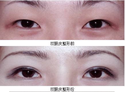 割<a href=http://m.f3bb6.cn/listinfo-724-0.html target=_blank class=infotextkey>雙眼皮</a>抽脂疼嗎