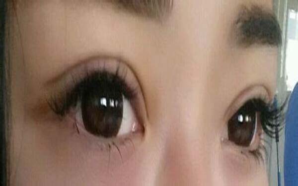 多層褶皺<a href=http://m.f3bb6.cn/listinfo-724-0.html target=_blank class=infotextkey>雙眼皮</a>怎么辦