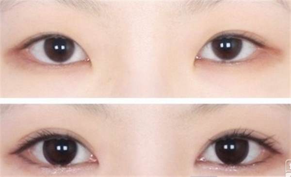 埋線法做<a href=http://m.f3bb6.cn/listinfo-724-0.html target=_blank class=infotextkey>雙眼皮</a>多少錢