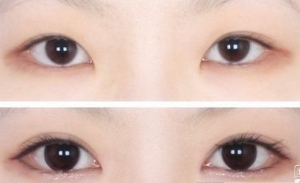 割<a href=http://m.f3bb6.cn/listinfo-724-0.html target=_blank class=infotextkey>雙眼皮</a>后幾天拆線