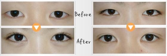 割<a href=http://m.f3bb6.cn/listinfo-724-0.html target=_blank class=infotextkey>雙眼皮</a>幾天能拆線