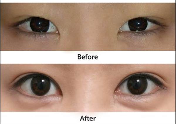 <a href=http://m.f3bb6.cn/listinfo-724-0.html target=_blank class=infotextkey>雙眼皮</a>寬變窄修復有哪些方式