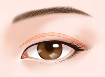 <a href=http://m.f3bb6.cn/listinfo-724-0.html target=_blank class=infotextkey>雙眼皮</a>埋線大概費用大致是多少