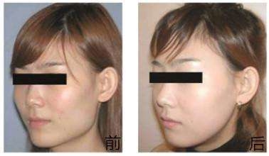 做<a href=http://m.f3bb6.cn/listinfo-629-0.html target=_blank class=infotextkey>下頜角</a>整形手術(shù)術(shù)后注意哪些呢