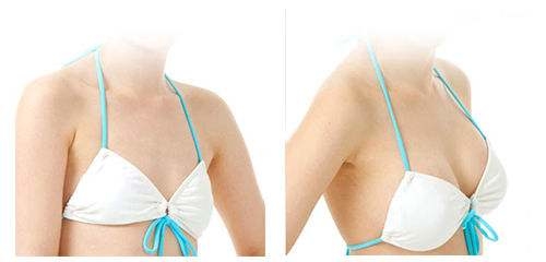 假體<a href=http://m.f3bb6.cn/listinfo-618-0.html target=_blank class=infotextkey>隆胸</a>后可以哺乳嗎