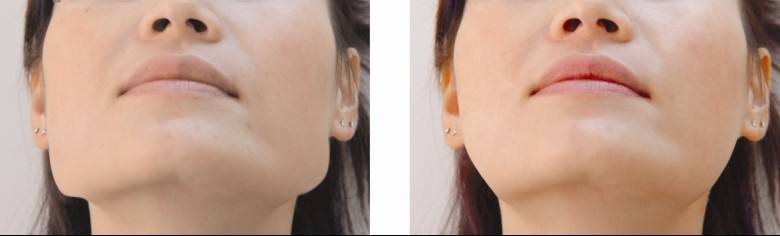 下<a href=http://m.f3bb6.cn/listinfo-644-0.html target=_blank class=infotextkey>頜骨整形</a>多久能恢復(fù)