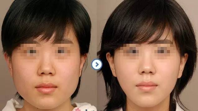 緊膚美容手術效果好嗎