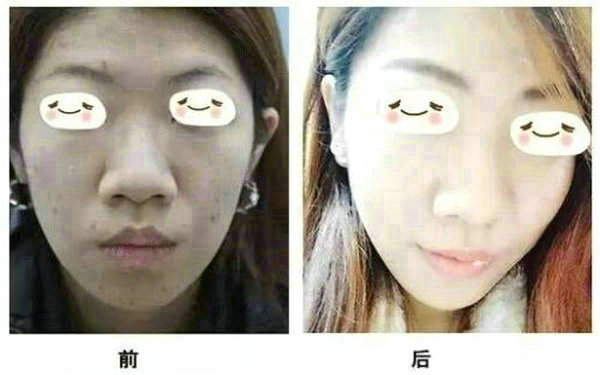 面部抽脂后注意事項?