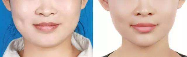 現在打<a href=http://m.f3bb6.cn/listinfo-631-0.html target=_blank class=infotextkey>瘦臉</a><a href=http://m.f3bb6.cn/listinfo-614-0.html target=_blank class=infotextkey>除皺</a>多少錢