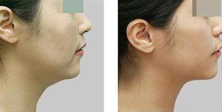 頜骨<a href=http://m.f3bb6.cn/listinfo-10-0.html target=_blank class=infotextkey>整形價格</a>