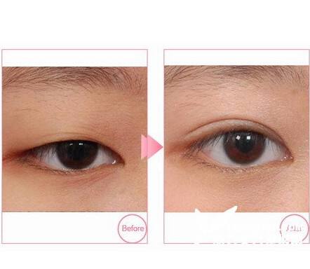 沈陽<a href=http://m.f3bb6.cn/listinfo-724-0.html target=_blank class=infotextkey>雙眼皮</a>手術價格