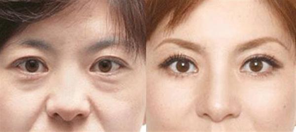 上臉下垂矯正術費用大致是多少