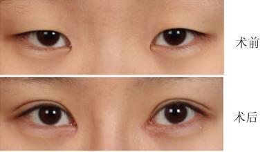小切口<a href=http://m.f3bb6.cn/listinfo-724-0.html target=_blank class=infotextkey>雙眼皮</a>幾天恢復