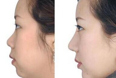 做完鼻部多項7天能恢復嗎