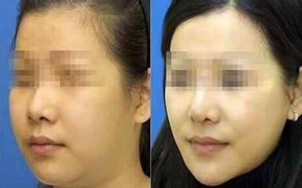 打<a href=http://m.f3bb6.cn/listinfo-631-0.html target=_blank class=infotextkey>瘦臉</a><a href=http://m.f3bb6.cn/listinfo-614-0.html target=_blank class=infotextkey>除皺</a>前后對比圖