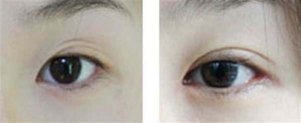 <a href=http://m.f3bb6.cn/listinfo-724-0.html target=_blank class=infotextkey>雙眼皮</a>怎么拆線過程圖效果對比