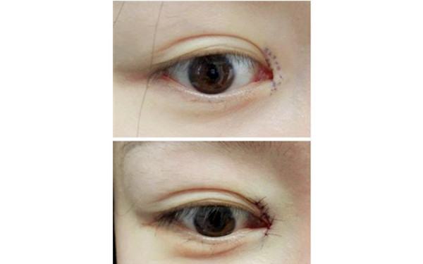 <a href=http://m.f3bb6.cn/listinfo-711-0.html target=_blank class=infotextkey>開眼角</a>五天拆線可以嗎