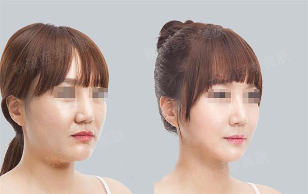 打完<a href=http://m.f3bb6.cn/listinfo-631-0.html target=_blank class=infotextkey>瘦臉</a><a href=http://m.f3bb6.cn/listinfo-614-0.html target=_blank class=infotextkey>除皺</a>多久吃飯