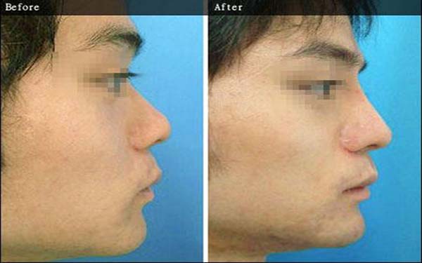 鼻部多項全麻還是局麻