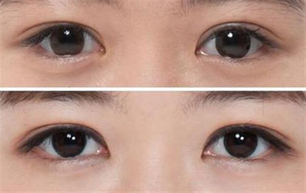 <a href=http://m.f3bb6.cn/listinfo-724-0.html target=_blank class=infotextkey>雙眼皮</a>全切1個(gè)月恢復(fù)圖效果對(duì)比