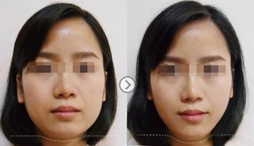 <a href=http://m.f3bb6.cn/listinfo-631-0.html target=_blank class=infotextkey>瘦臉</a><a href=http://m.f3bb6.cn/listinfo-614-0.html target=_blank class=infotextkey>除皺</a>有什么后遺癥