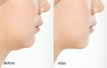 脸部溶脂多少钱