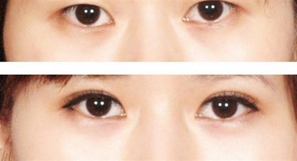 <a href=http://m.f3bb6.cn/listinfo-724-0.html target=_blank class=infotextkey>雙眼皮</a>7mm一年后照片效果對比