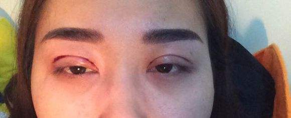 割了<a href=http://m.f3bb6.cn/listinfo-724-0.html target=_blank class=infotextkey>雙眼皮</a>喝酒會怎樣