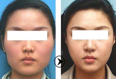 风险较小的整脸手术