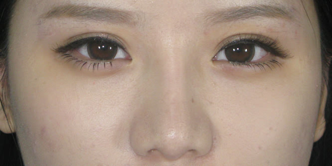 做鼻部多項多少錢