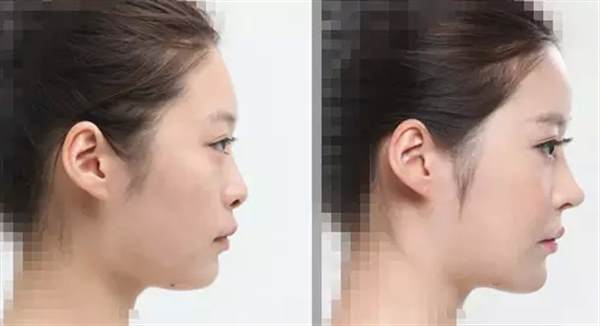 做鼻部多項可以維持多久