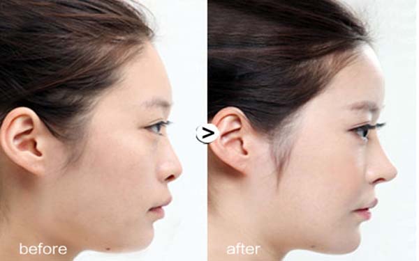 硅膠假體<a href=http://m.f3bb6.cn/listinfo-737-0.html target=_blank class=infotextkey>隆鼻</a>優勢及效果