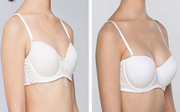 硅膠假體<a href=http://m.f3bb6.cn/listinfo-618-0.html target=_blank class=infotextkey>隆胸</a>多少錢？