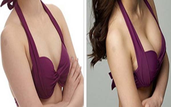 硅膠假體<a href=http://m.f3bb6.cn/listinfo-618-0.html target=_blank class=infotextkey>隆胸</a>后2個(gè)月對(duì)比