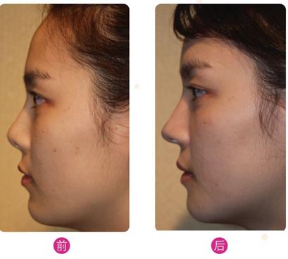 鼻頭整形手術后的護理要點都有哪些