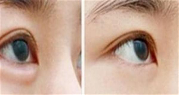 眼袋抽脂的費用怎么收