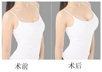 自体脂肪丰胸有哪些优势呢