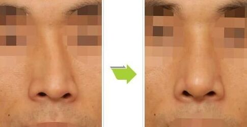 <a href=http://m.f3bb6.cn/listinfo-751-0.html target=_blank class=infotextkey>歪鼻矯正</a>手術價格是多少